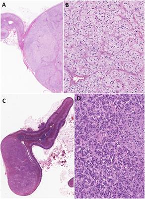 The Many Faces of Primary Aldosteronism and Cushing Syndrome: A Reflection of Adrenocortical Tumor Heterogeneity